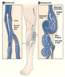 stocarea elastica pe shin of varicose