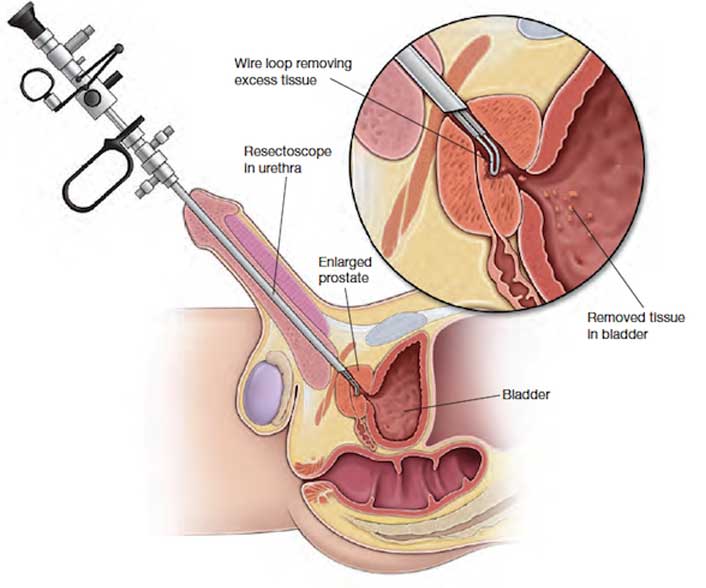 enlarged prostate surgery)