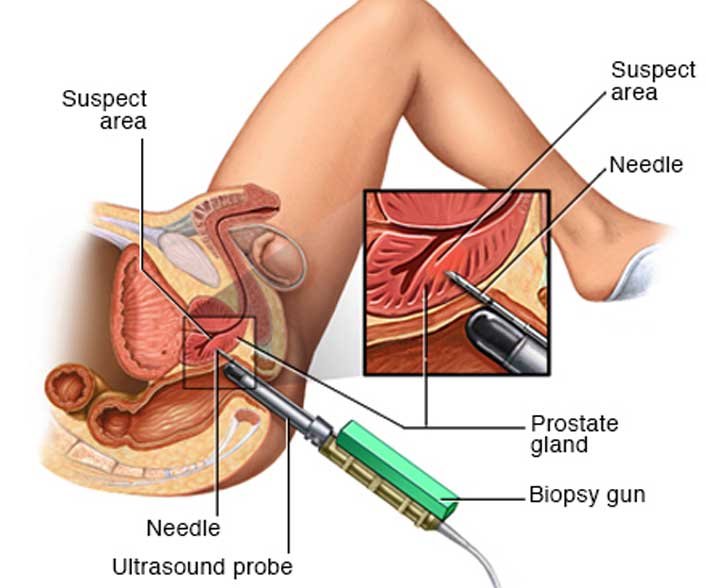 Stasis prostatitis